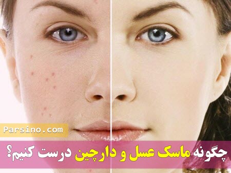 درمان جوش صورت با طب سنتی , درمان جوش صورت با عسل