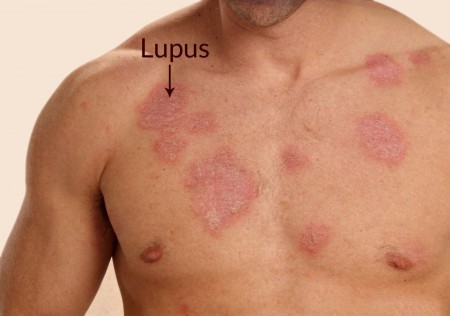 نشانه های بیماری لوپوس , بیماری لوپوس در کودکان
